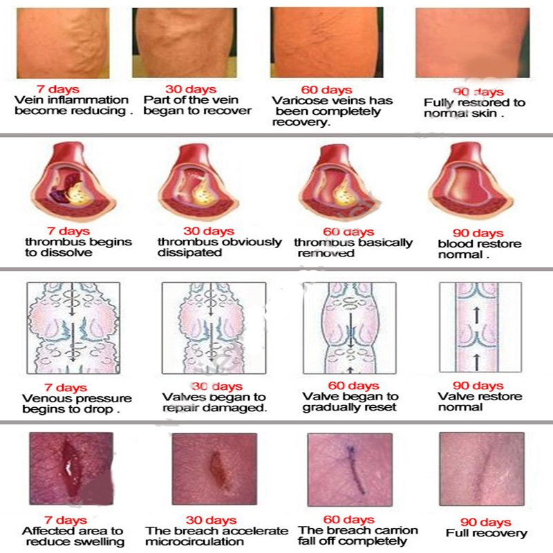 Lumbar vertebrae pain and pain